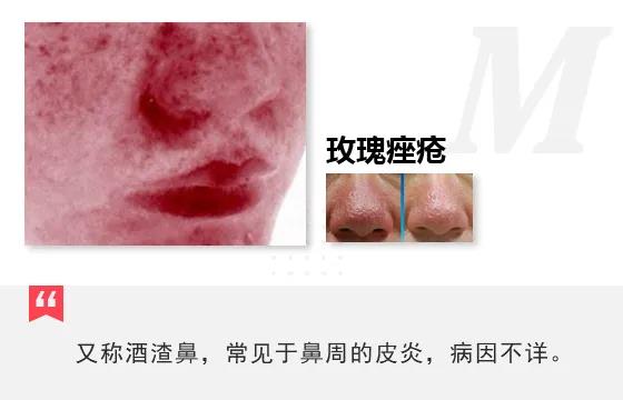 眼睑、鼻子周围长红包疹子，是激素皮炎还玫瑰痤疮 案例分析